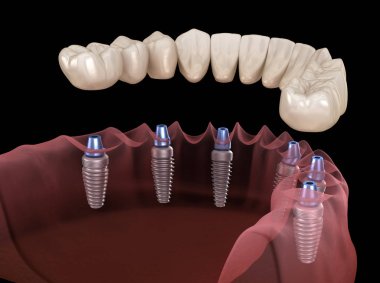 Çene protezi. Hepsi de implantlarla desteklenen 6 sistemde. İnsan dişleri ve protez kavramının tıbben doğru üç boyutlu çizimi