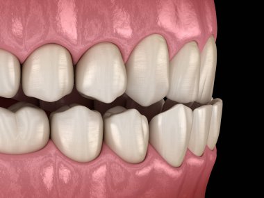 Underbite diş tıkanıklığı ( Dişlerin maloklüzyon ). Tıbbi olarak doğru diş 3d illüstrasyon