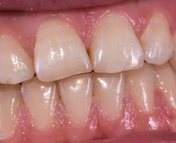 Sağlıklı insan dişleri - kesici dişler, frontal yakın görünüm