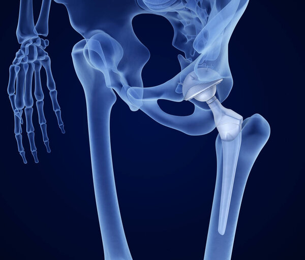 Hip replacement implant installed in the pelvis bone. X-ray view. Medically accurate 3D illustration