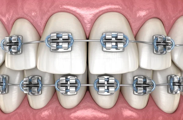 Teeth with metal braces in gums. Medically accurate dental 3D illustration