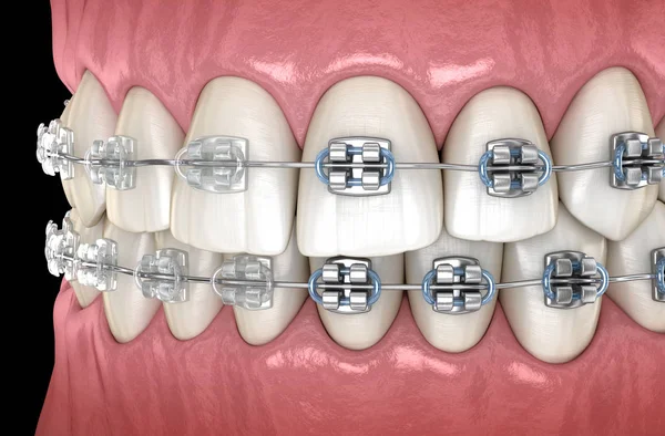 Denti Con Metallo Bretelle Trasparenti Nelle Gengive Illustrazione Dentale Clinicamente — Foto Stock