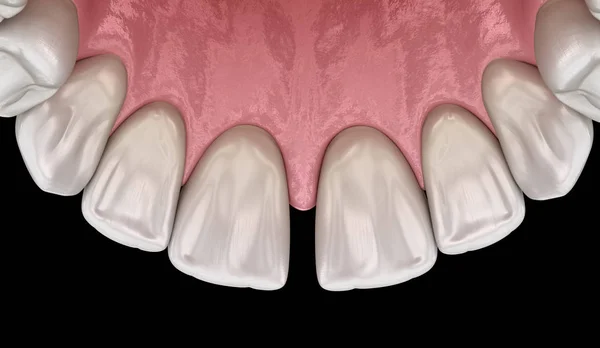Diastema Dientes Incisivos Centrales Disfunción Dental Concepto Ilustración — Foto de Stock