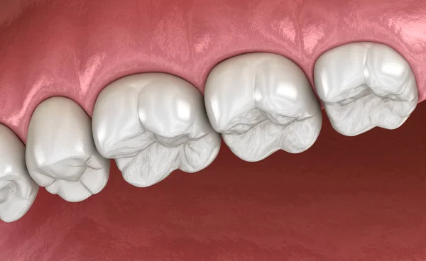 Oberkiefer Zahnfleisch Und Zähne Medizinisch Korrekte Darstellung Der Zähne — Stockfoto