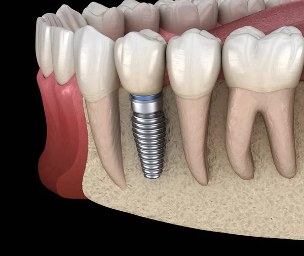 Recuperación Dental Preremolar Con Implante Ilustración Médicamente Precisa Del Concepto — Foto de Stock