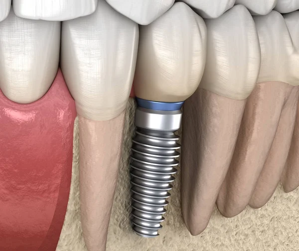 Prämolare Zahnsanierung Mit Implantat Medizinisch Genaue Abbildung Des Konzepts Menschlicher — Stockfoto