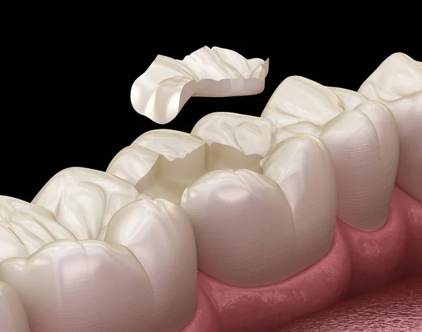 Inlay Keramikkrone Fixierung Über Den Zahn Medizinisch Genaue Abbildung Der — Stockfoto