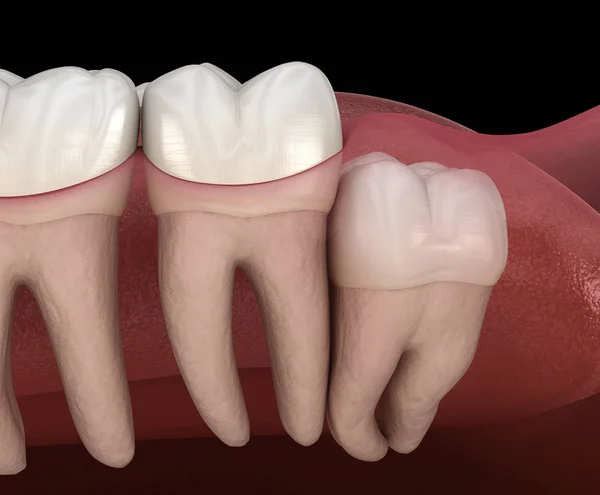 Gesunde Zähne Und Weisheitszähne Mit Senkrechtem Aufprall Medizinisch Korrekte Abbildung — Stockfoto