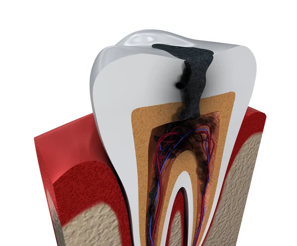 Caries Dental Ilustración Dientes Médicamente Precisos — Foto de Stock