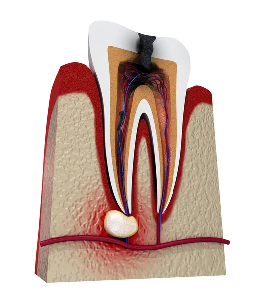 Carie Dentarie Illustrazione Del Dente Clinicamente Accurata — Foto Stock