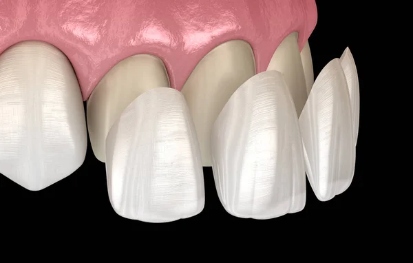 在中央门牙和侧牙上安装嵌板的程序 医学上准确的牙齿3D图像 — 图库照片
