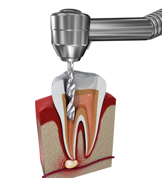 Wurzelkanalbehandlung Illustration — Stockfoto