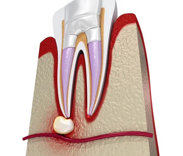 Diagrama Del Procedimiento Rellenos Dentales Ilustración — Foto de Stock