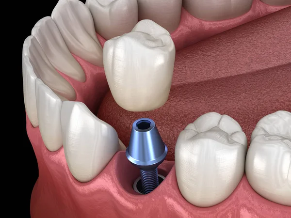 Premolární Instalace Zubní Koruny Nad Implantátem Lékařsky Přesná Ilustrace Konceptu — Stock fotografie