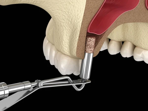 Chirurgie Des Sinus Ajout Nouvel Illustration — Photo