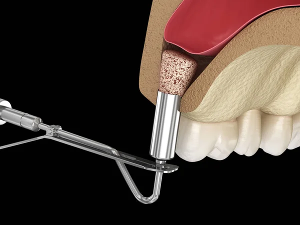 鼻窦升降外科 增加新的骨头 3D插图 — 图库照片
