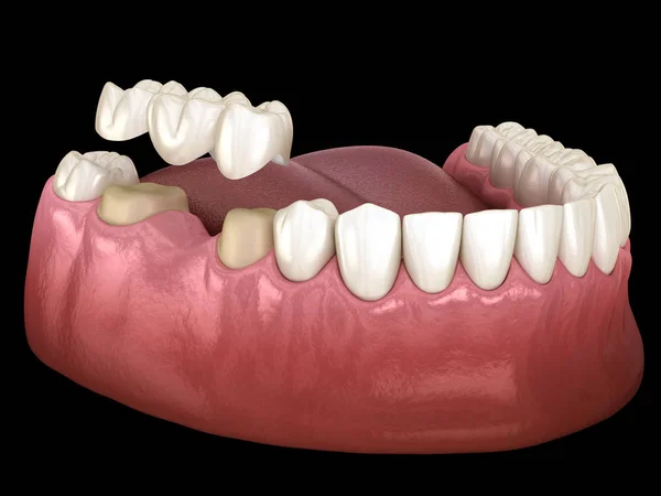Ponte Dentária Dentes Sobre Molar Pré Molar Ilustração Medicamente Precisa — Fotografia de Stock