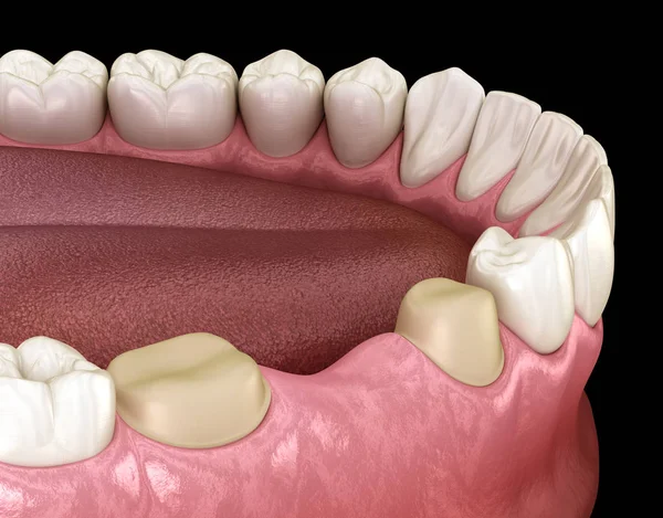 Підготовлений Молярний Передполярний Зуб Розміщення Зубного Моста Медично Точна Ілюстрація — стокове фото
