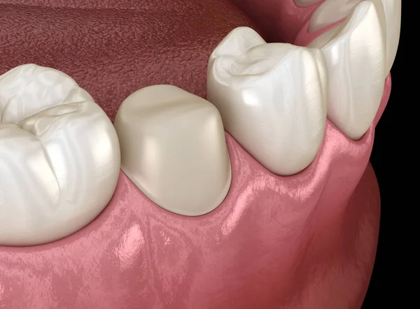 Підготовлений Передпологовий Зуб Розміщення Зубної Коронки Медично Точна Ілюстрація — стокове фото