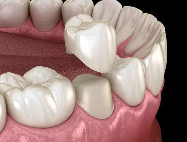 Οδοντιατρική Στεφάνη Προμοριακή Διαδικασία Συναρμολόγησης Των Δοντιών Ιατρικά Ακριβής Απεικόνιση — Φωτογραφία Αρχείου