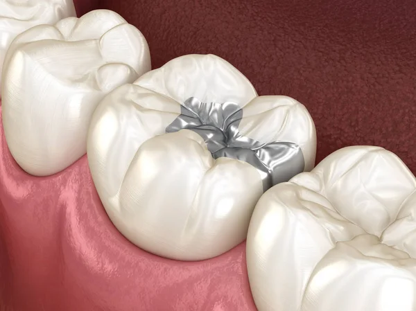 Вкласти Фіксацію Срібної Корони Зуб Медично Точна Ілюстрація Лікування Зубів — стокове фото