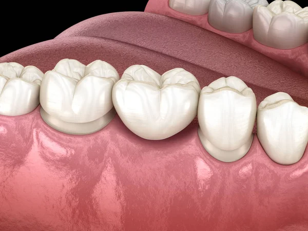 Ponte Dentale Denti Sopra Molare Premolare Illustrazione Clinicamente Accurata Del — Foto Stock