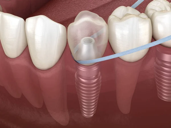 Nettoyage Des Dents Par Implant Dentaire Avec Fil Dentaire Illustration — Photo