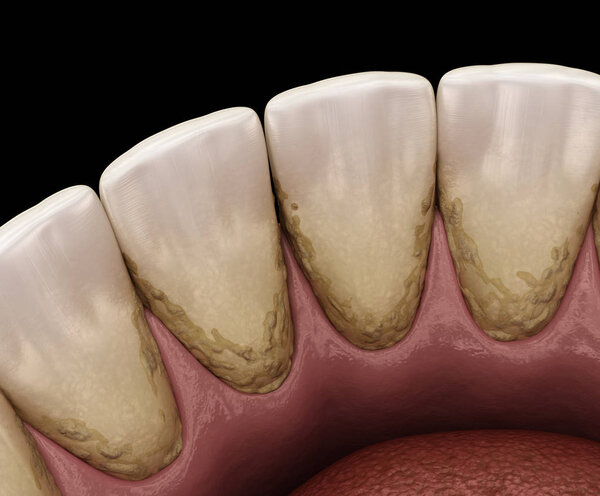 Tartar and bactrail tooth plaque, lower jaw. Medically accurate 3D illustration of human teeth treatment
