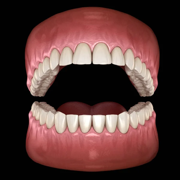 Anatomie Dentaire Prothèses Dentaires Ouvertes Illustration Dentaire Médicalement Précise — Photo