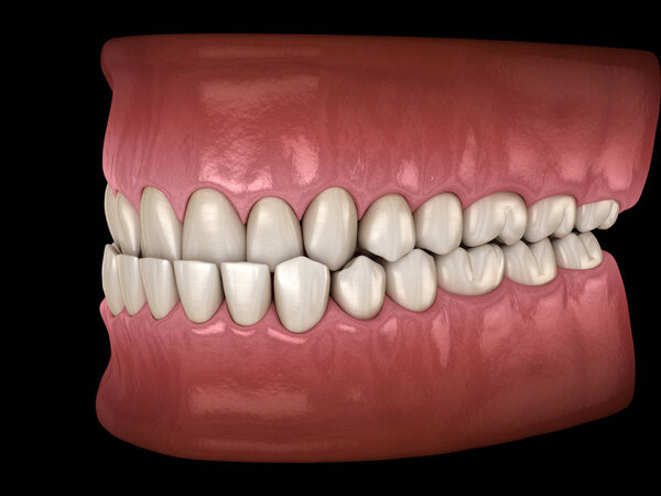 Underbite dental occlusion ( Malocclusion of teeth ). Medically accurate tooth 3D illustration