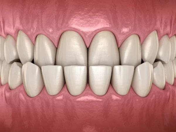 Podušení Zubařské Okluzu Malockluzi Zubů Medově Přesný Zubní Zub Ilustrace — Stock fotografie