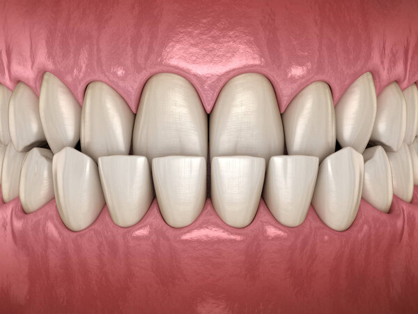 Underbite dental occlusion ( Malocclusion of teeth ). Medically accurate tooth 3D illustration