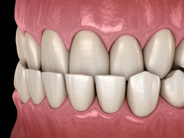 咬牙咬紧 牙齿的闭塞 医学上精确的牙齿 — 图库照片