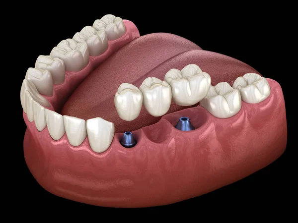 Puente Dental Soportado Por Implantes Ilustración Médicamente Precisa Del Concepto — Foto de Stock