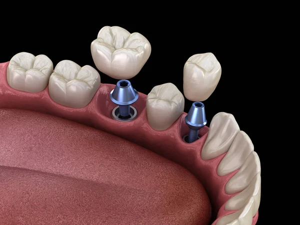 Установка Премолярной Зубной Коронки Поверх Опор Имплантатов Медицинская Точность Иллюстрации — стоковое фото