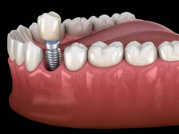 Premolární Instalace Zubní Koruny Nad Implantátem Lékařsky Přesná Ilustrace Konceptu — Stock fotografie