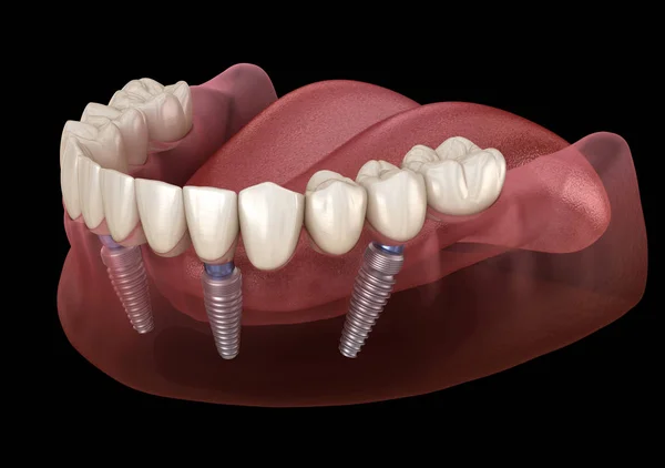 Prótese Mandibular Todos Sistema Suportado Por Implantes Ilustração Medicamente Precisa — Fotografia de Stock