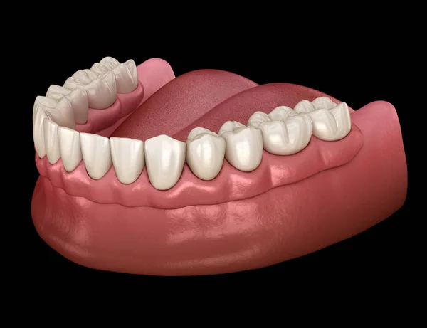 Çene Protezi Hepsi Implantlarla Desteklenen Sistemde Nsan Dişleri Protez Kavramının — Stok fotoğraf