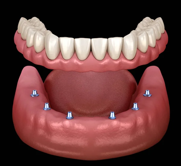 Unterkieferprothese Alles Auf System Das Durch Implantate Unterstützt Wird Medizinisch — Stockfoto