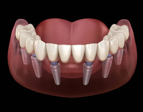 下颌骨假体全部安装在6个由植入物支撑的系统上 医学上准确的人类牙齿和假牙概念三维图像 — 图库照片