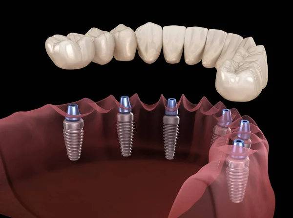 Prótese Mandibular Todos Sistema Suportado Por Implantes Ilustração Medicamente Precisa — Fotografia de Stock
