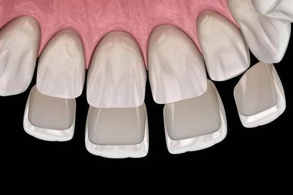 中央インジケータと横インジケータ上のベネー設置手順 医学的に正確な歯3Dイラスト — ストック写真
