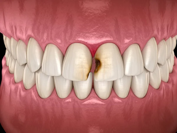 Центральный Резец Зубов Поврежден Кариесом Медицинская Точность Трехмерной Иллюстрации Зубов — стоковое фото
