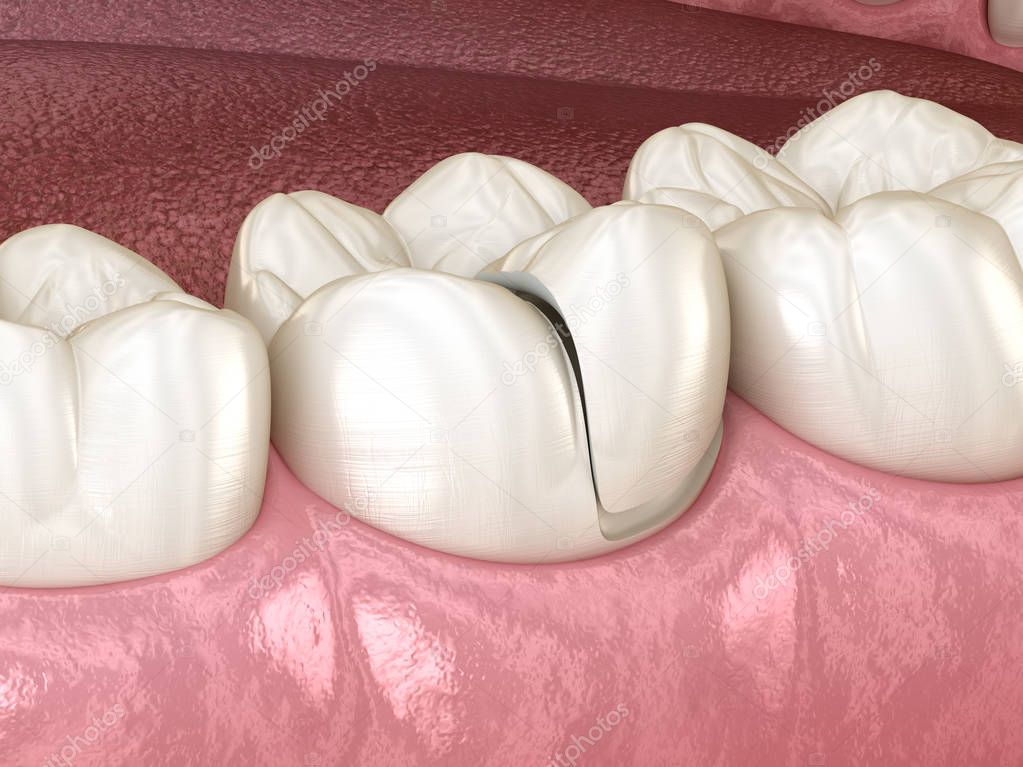 Onlay ceramic crown fixation over tooth. Medically accurate 3D illustration of human teeth treatment