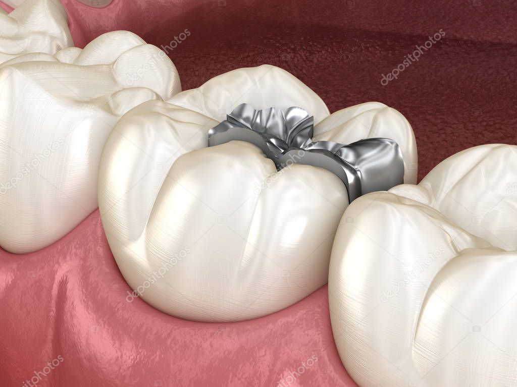 Inlay silver crown fixation over tooth. Medically accurate 3D illustration of human teeth treatment