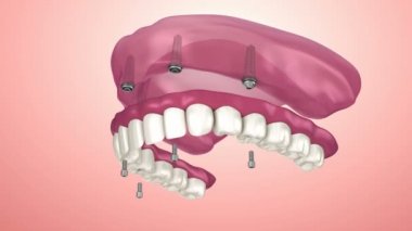 Overdenture implant - top ekleri, yerleştirme işlemi oturmak için. 3D animasyon