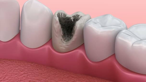 Dentes com inspeção de cárie. Animação 3D . — Vídeo de Stock