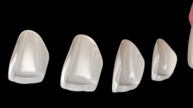 Merkezi kesici diş ve lateral kesici üzerine kaplama montaj prosedürü. Tıbbi olarak doğru diş 3d animasyon