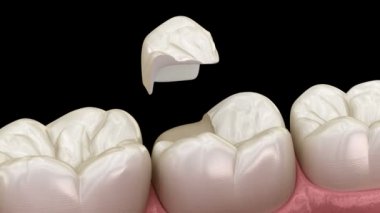 Diş üzerinde Onlay seramik taç fiksasyon. İnsan diş tedavisi tıbbi olarak doğru 3d animasyon