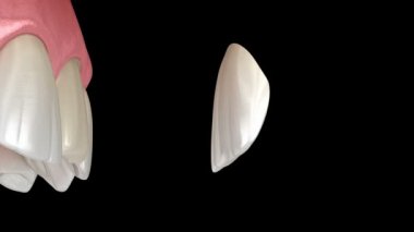 Merkezi kesici diş üzerinde Veneer kurulum prosedürü. Tıbbi olarak doğru diş 3D illüstrasyon